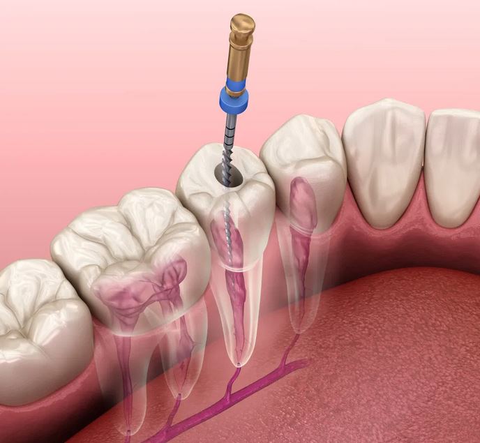 Endodoncia y Cirugía Apical