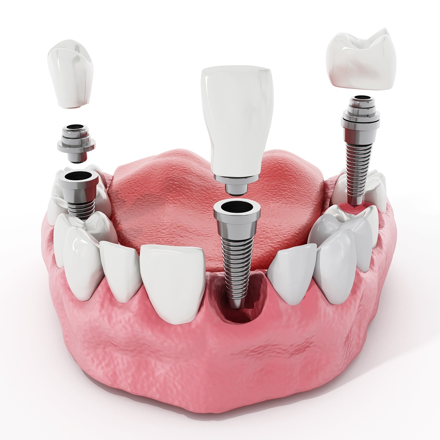 Implantología Dental Avanzada