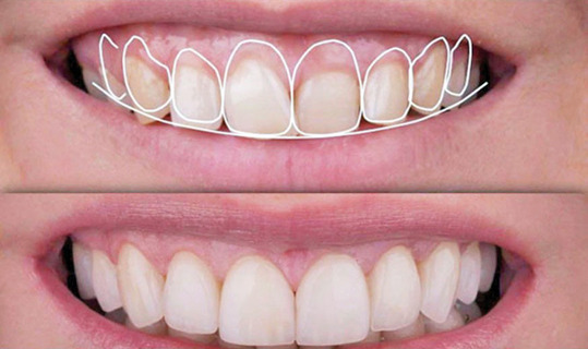 Corrección sonrisa gingival - TMJ Clinic Barcelona