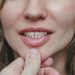 Maloclusiones transversales - TMJ Clinic Barcelona