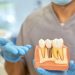 Mallas subperiósticas en implantología dental - TMJ Clinic