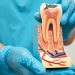 Afecciones perirradiculares - TMJ Clinic